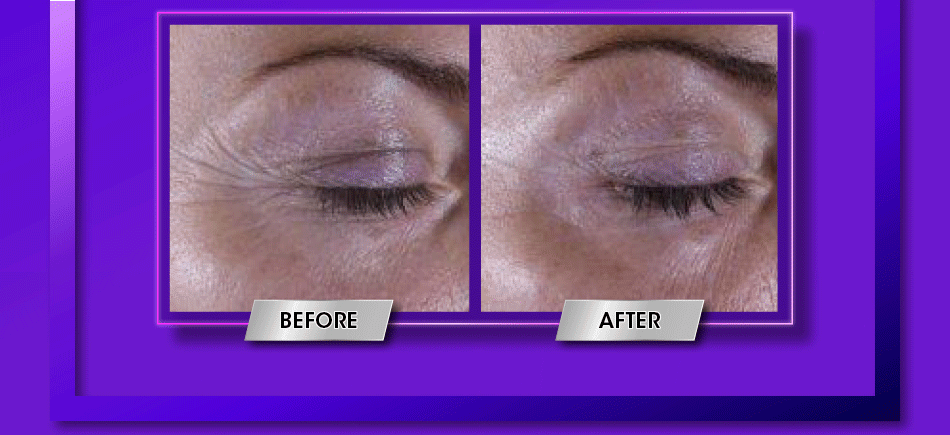 Super Multi-Corrective Eye Zone Treatment use before and after