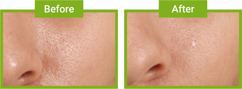 Before and After about using Kiehl’s Pore-minimizing & Polishing Powder Cleanser