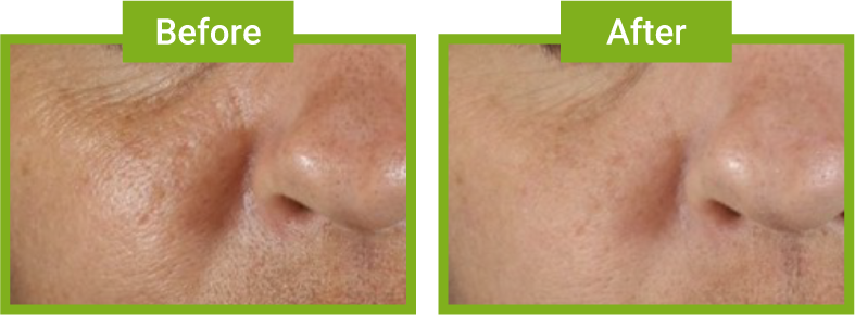 Before and After about using Rare Earth Deep Pore Cleansing Masque, which reduces excess oil and clogged pores